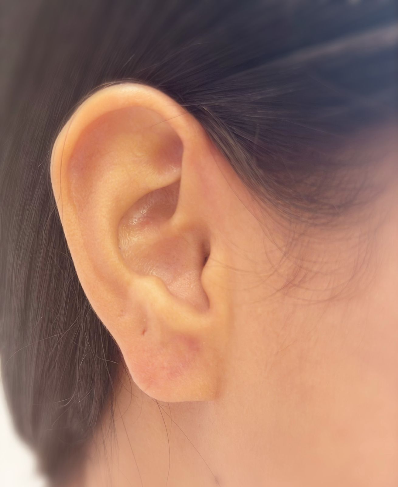Orelha corrigida após lobuloplastia na Ame Piercing em Sete Lagoas